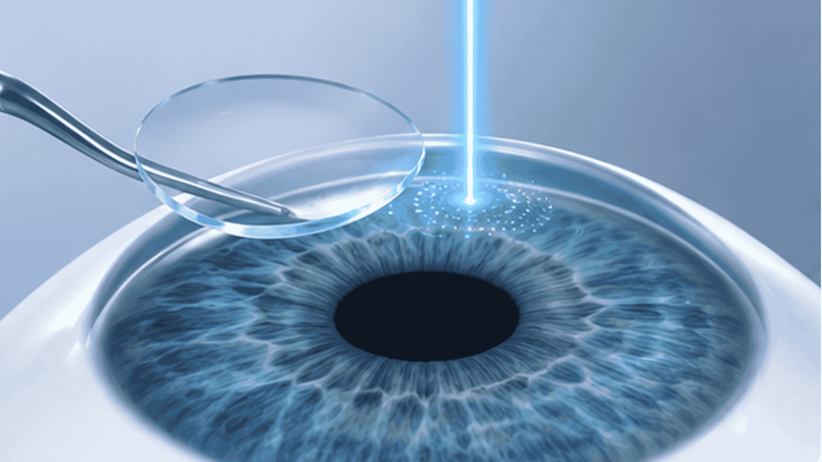 LASIK